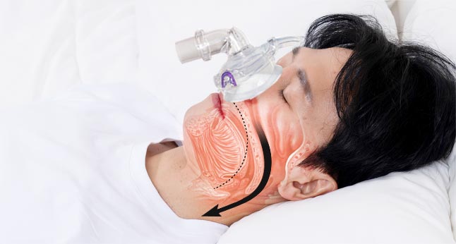 cpap 사용 후