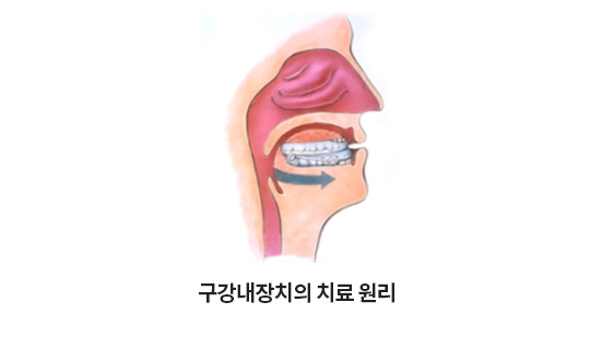 구강내장치의 치료 원리